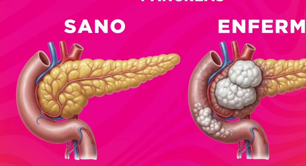 Un doctor explica cómo la pancreatitis afecta el manejo del azúcar tras las comidas