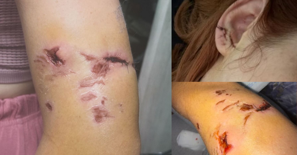 ¡Terror! Bailarina tica fue atacada por rottweiler y muestra sus heridas