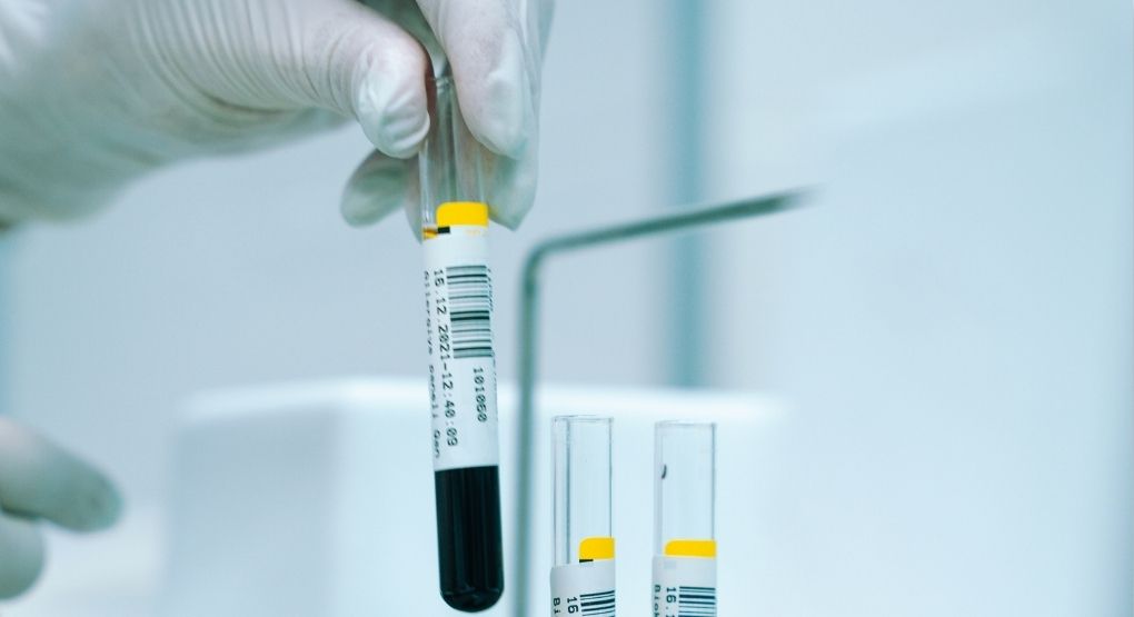 ¿Necesita hacerse pruebas para manejar el colesterol? Doctora explica proceso para medirlo