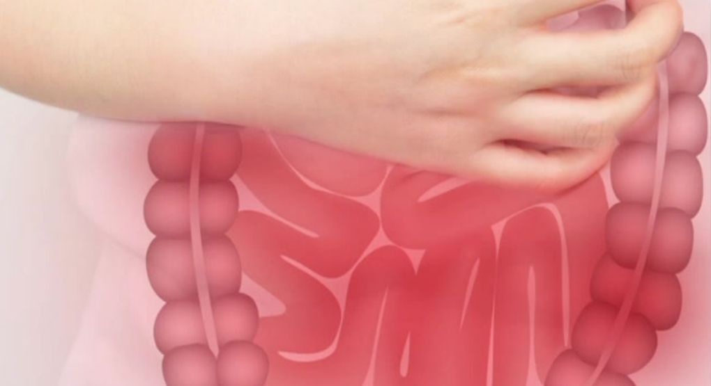 Adultos jóvenes, cada vez más propensos al cáncer de colon: Doctor explica sobre el tema