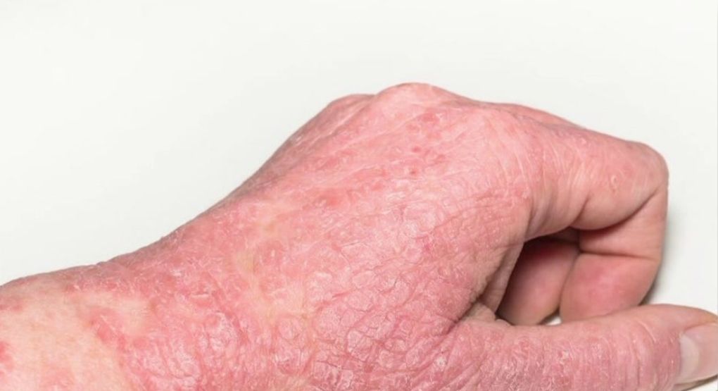 Piel roja con picazón: Aprenda a identificar síntomas de una posible alergia