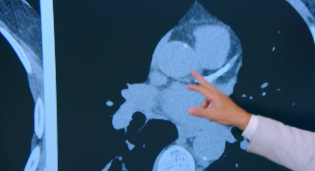 ¿Sus arterias están enviando señales de alerta? Do